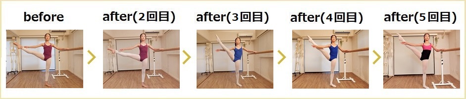 バレエ整体・アラスゴンドの改善例